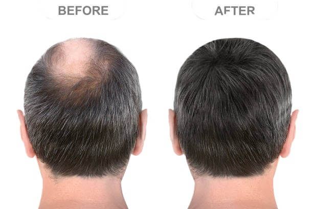 Male crown before and after treatment