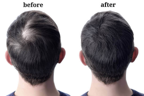 Rear scalp before and after