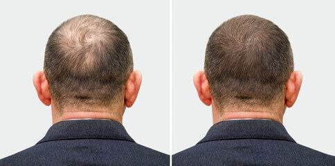 Before and after image of a mature man's crown showing partial regrowth on a diffusely thinning area.