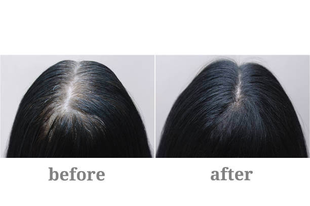 Female part line before and after