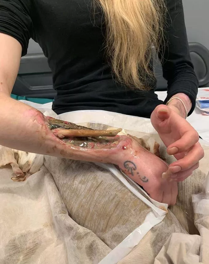 Joint Inflammation