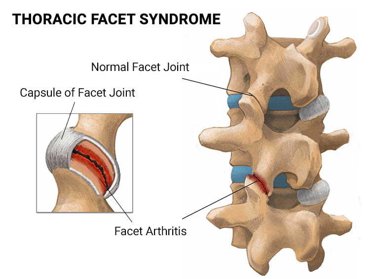 Joint Inflammation