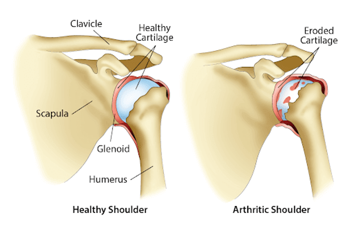 Joint Inflammation